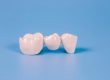 puente dental fijo