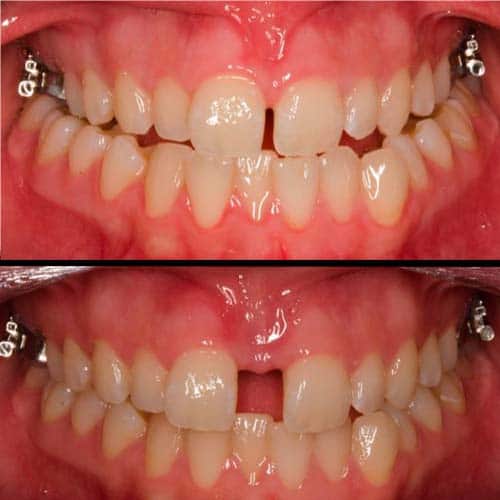 caso antes y despues de expansion maxilar caso antes y despues de expansion maxilar