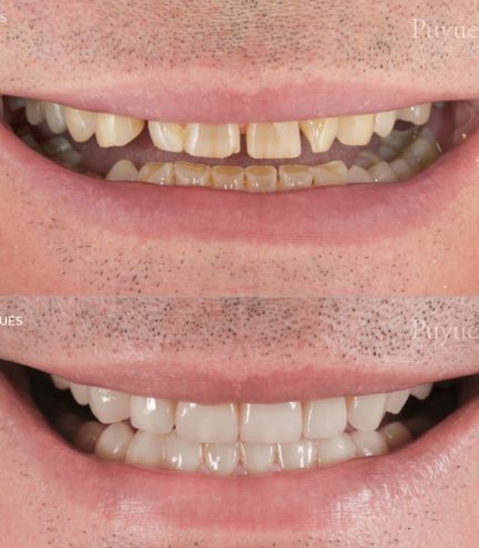 antes y despues desgastes dentales con carillas