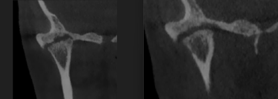 despues crujido mandibular despues crujido mandibular