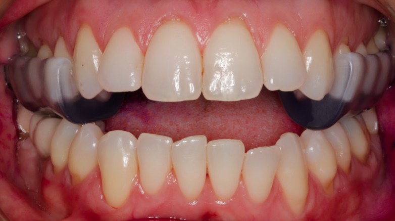ferula de desprogramacion dental clinica puyuelo barcelona