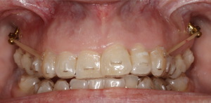 microtornillos con ortodoncia invisalign
