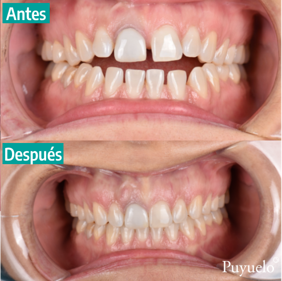 Caso real 2 comparación dientes microtornillos Barcelona Clínica Puyuelo